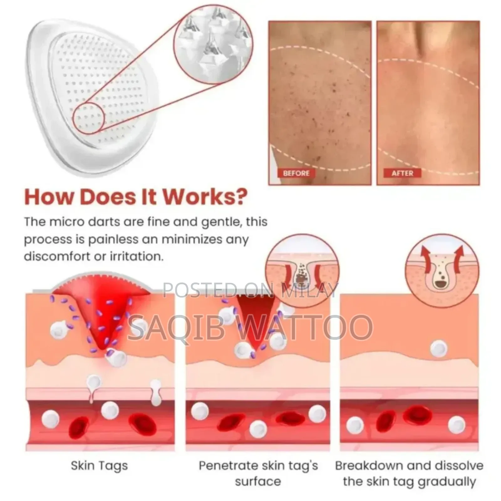 Dermasmooth Skin Tag Remover Patch | Fast, Safe Painles